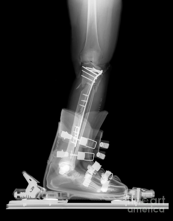 X-ray Of Broken Bones In Ski Boot #2 Photograph by Ted Kinsman