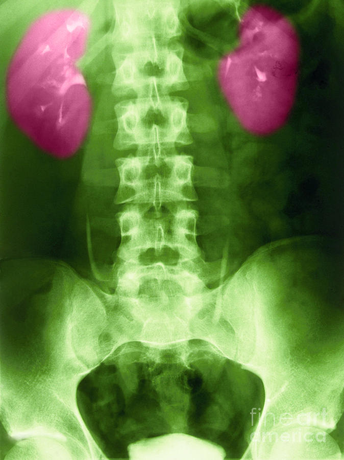 X-ray Of Normal Kidneys #2 Photograph by Science Source