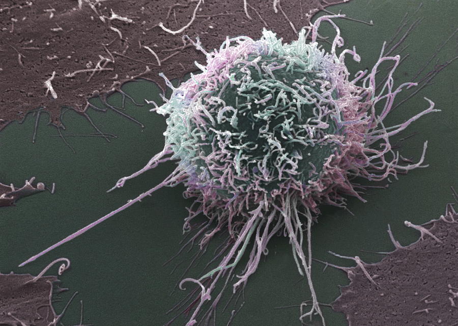 Cervical Cancer Cell, Sem Photograph by Steve Gschmeissner - Fine Art ...