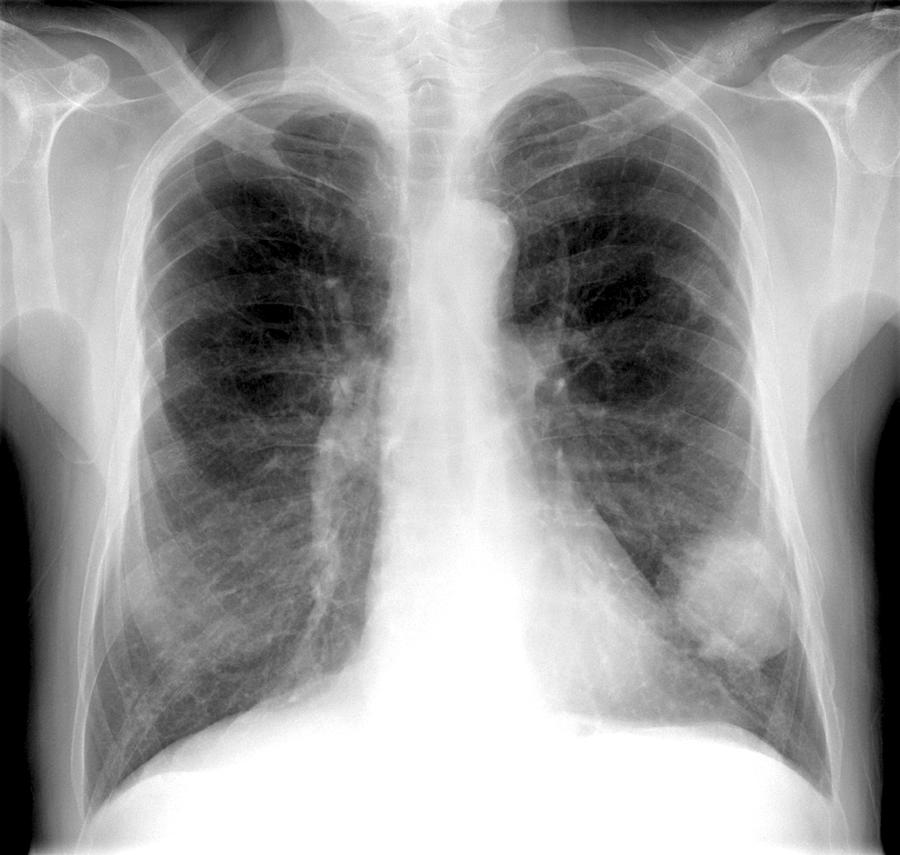 Lung Cancer, X-ray Photograph by Du Cane Medical Imaging Ltd