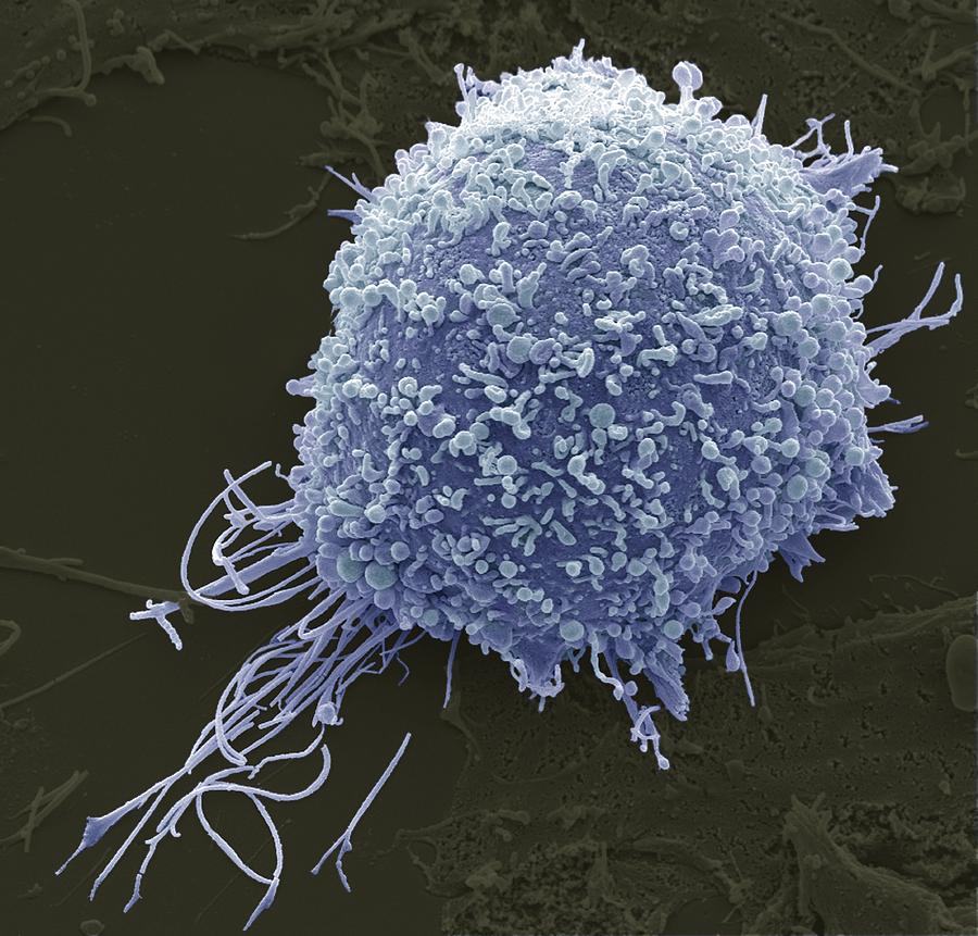 Cervical Cancer Cell, Sem Photograph by Steve Gschmeissner - Fine Art ...