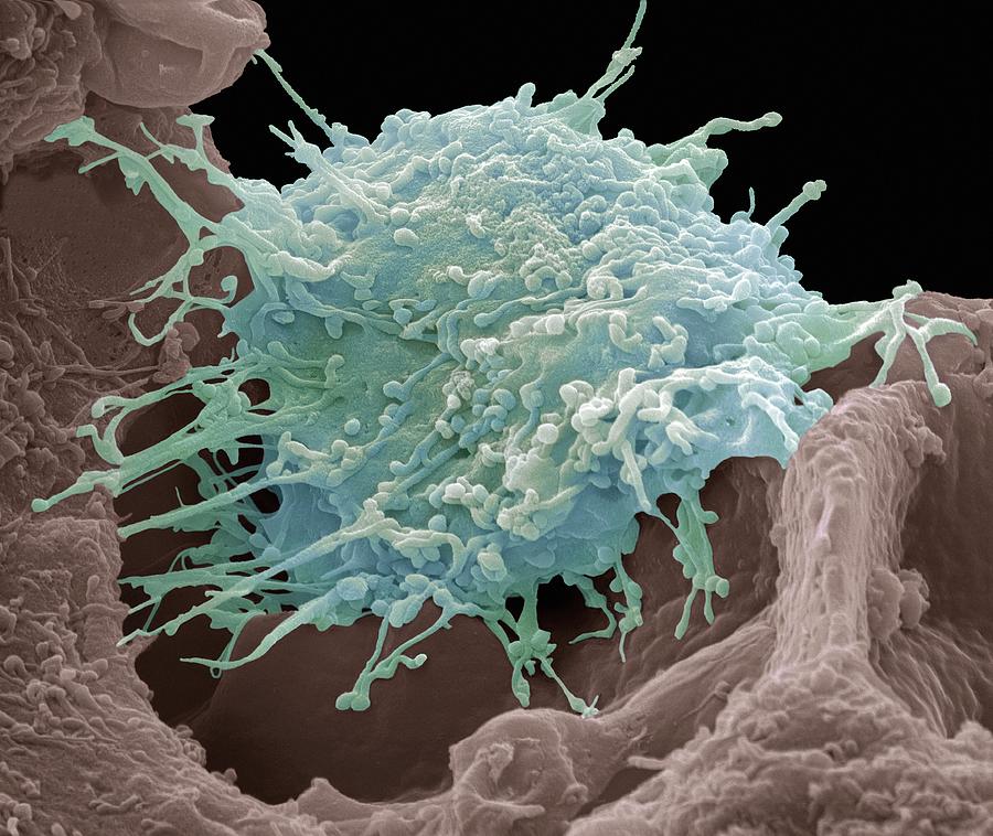 Cervical Cancer Cell, Sem Photograph by Steve Gschmeissner - Fine Art ...