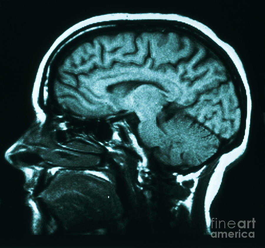 Mri Of Normal Brain #49 Photograph by Science Source