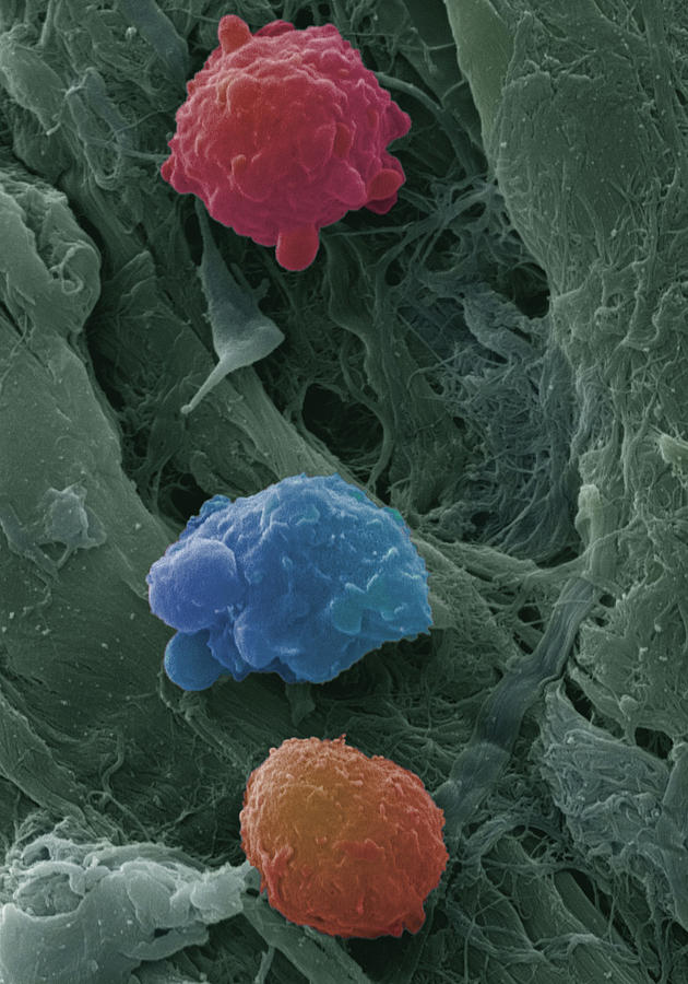 Myeloid Photograph - Leukaemia Blood Cells, Sem #25 by Steve Gschmeissner