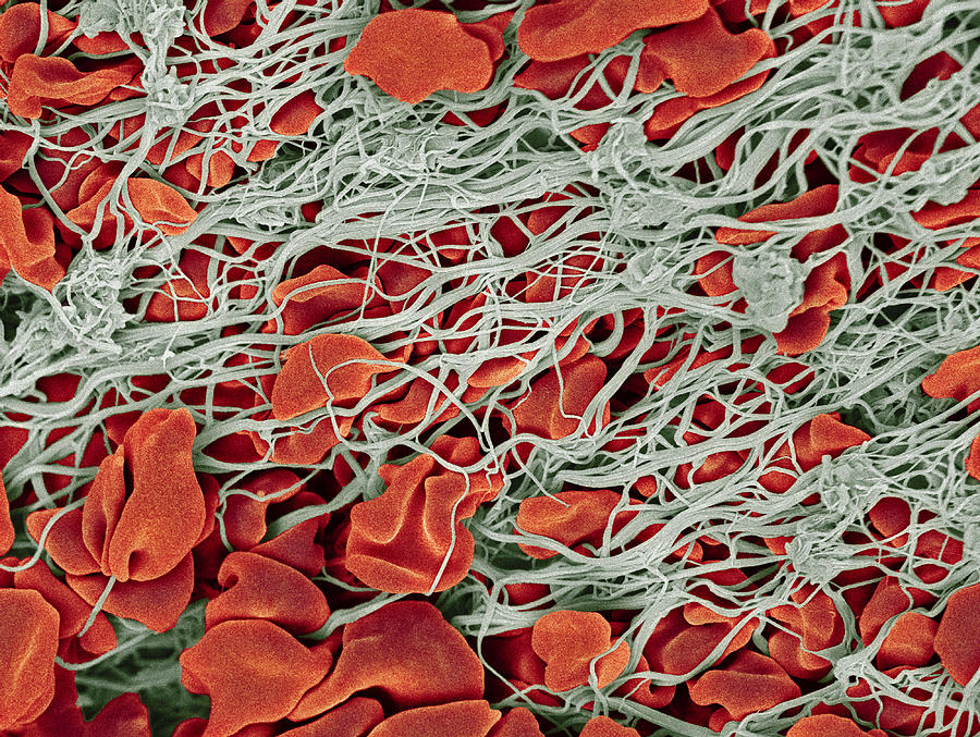 Red and white blood cells in clot, SEM - Stock Image - C045/8688 - Science  Photo Library