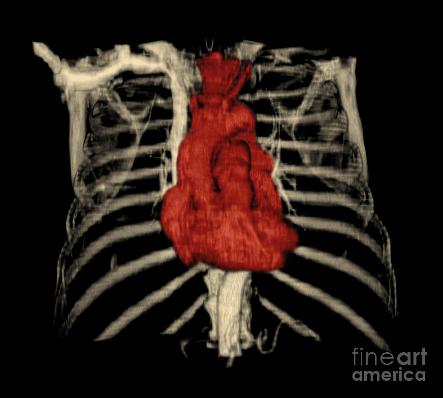 3d Ct Reconstruction Of Heart Photograph by Medical Body Scans