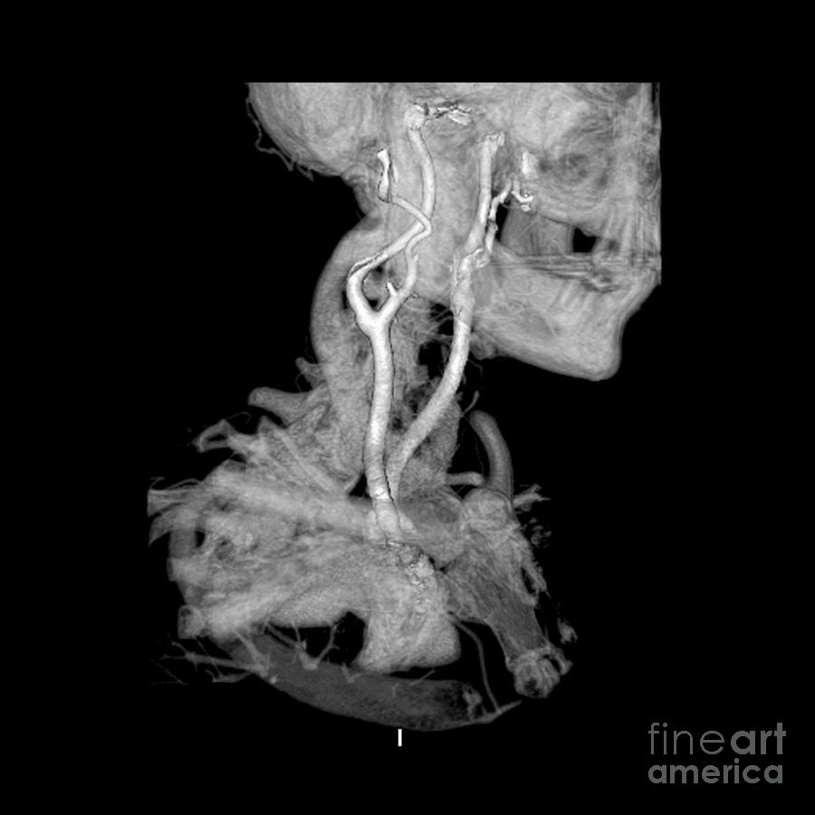3d Cta Of Carotid Arteries Photograph by Medical Body Scans