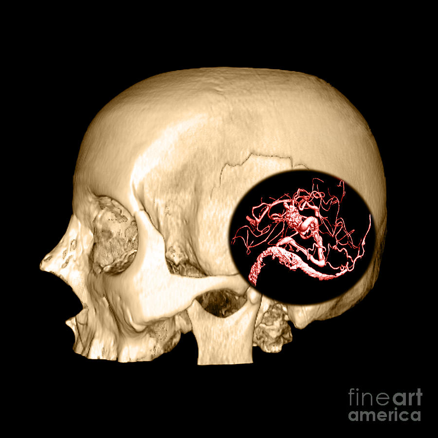 3d Image Of Skull And Brain Avm Photograph by Medical Body Scans