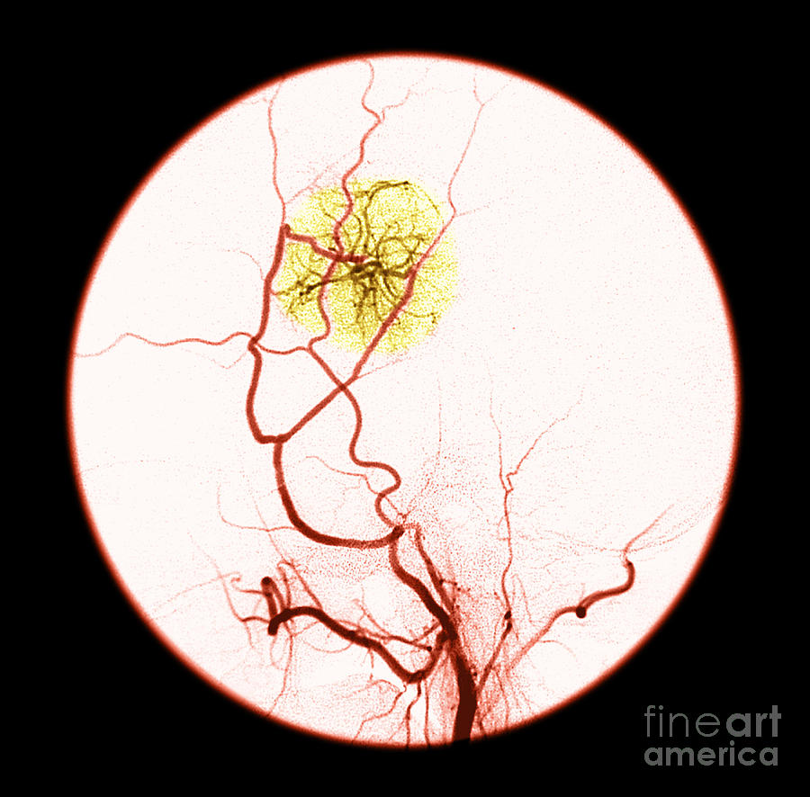 Abnormal Blood Flow #3 Photograph by Medical Body Scans