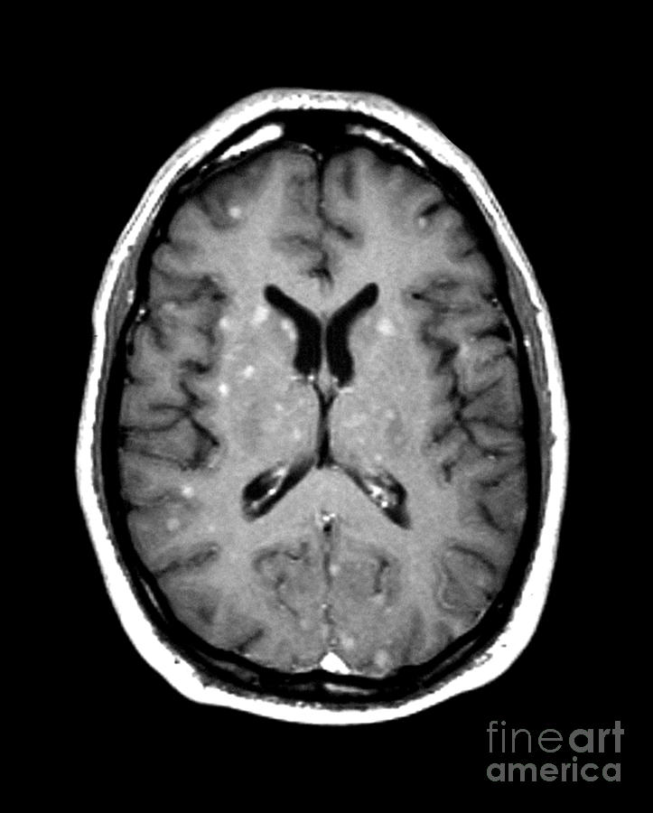 Abnormal Mri Of Brain #3 Photograph by Medical Body Scans