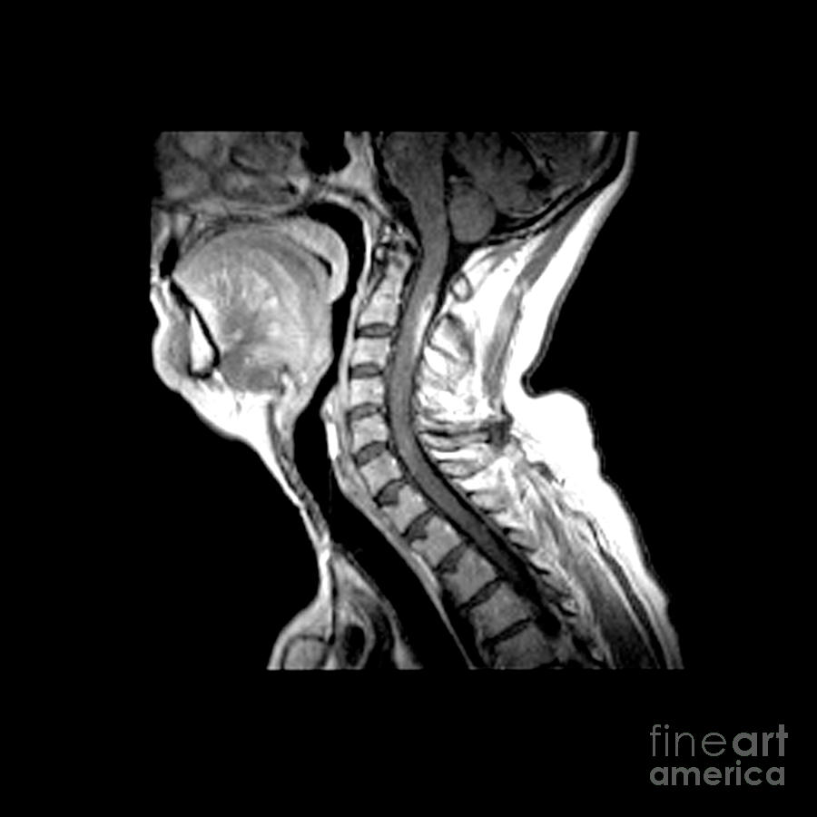 Active Demyelination Of Spinal Cord #3 Photograph by Medical Body Scans