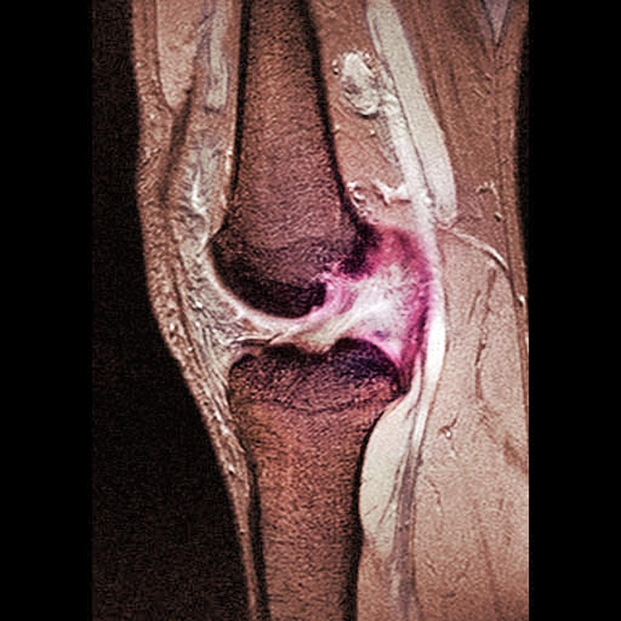 https://images.fineartamerica.com/images-medium-large/3-anterior-cruciate-ligament-tear-ct-scan-du-cane-medical-imaging-ltd.jpg