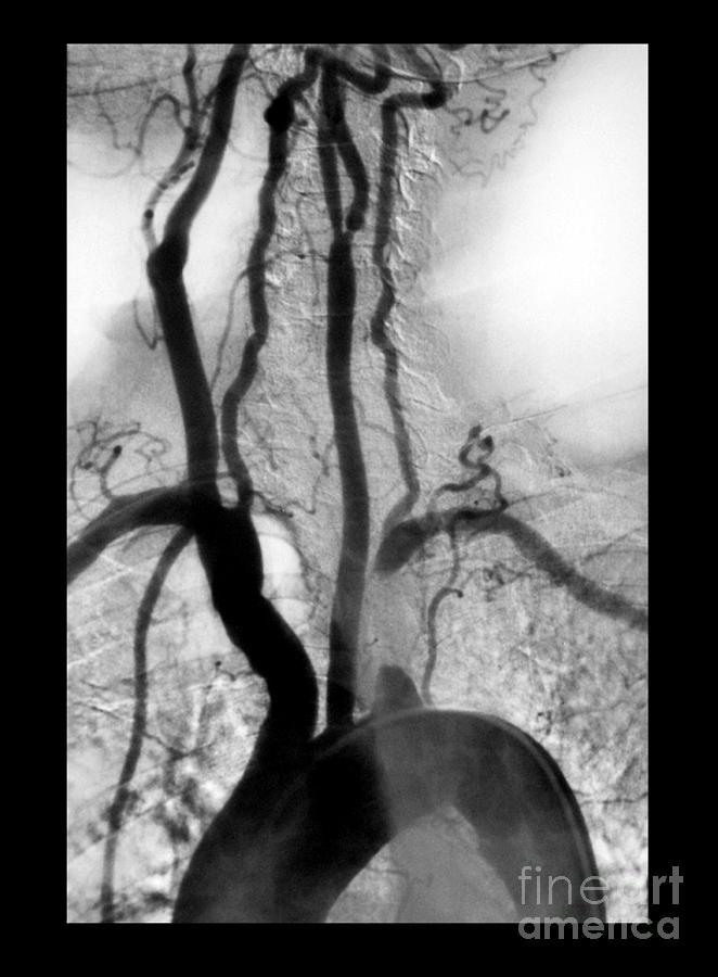 Aortic Arch Angiogram Photograph - Aortic Arch Angiogram #3 by Medical Body Scans