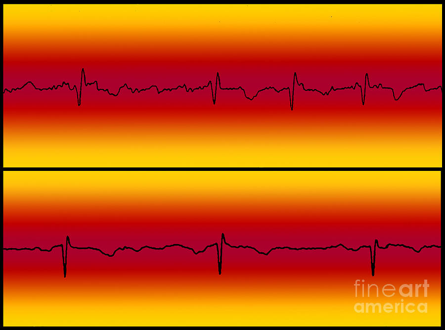 Atrial Flutter and Normal Heart Beat Photograph by Science Source