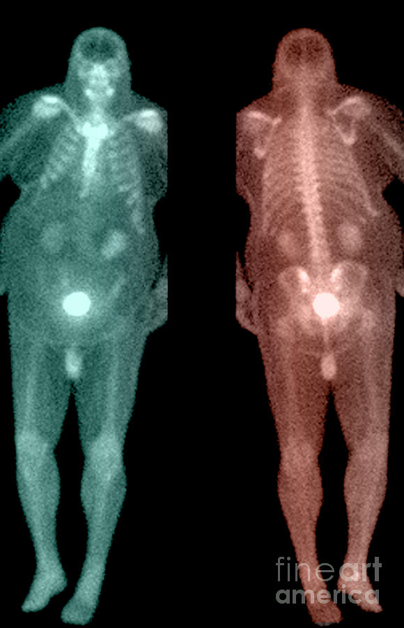 Bone Scan #3 Photograph by Medical Body Scans