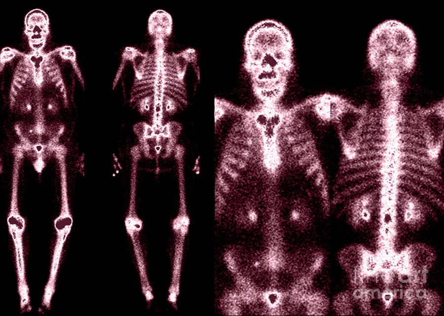 Bone Scans #3 Photograph by Medical Body Scans