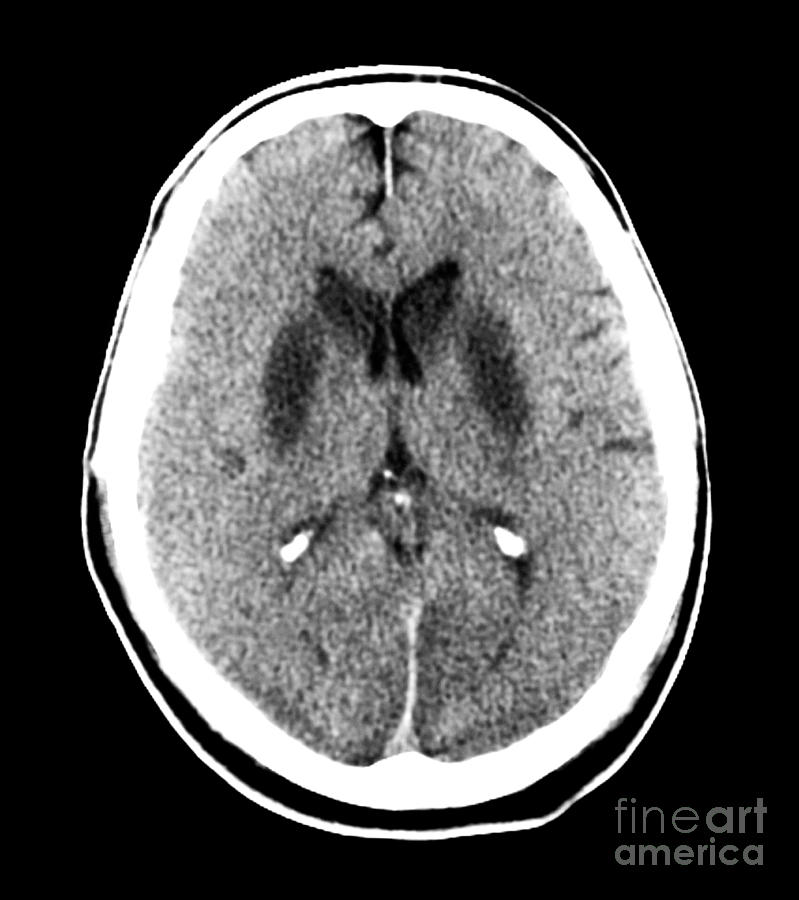 Brain Of A Cardiac Arrest Victim #3 Photograph by Medical Body Scans