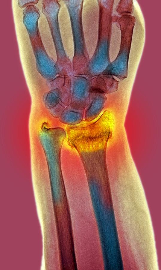 Broken Wrist, X-ray Photograph by Du Cane Medical Imaging Ltd | Fine ...