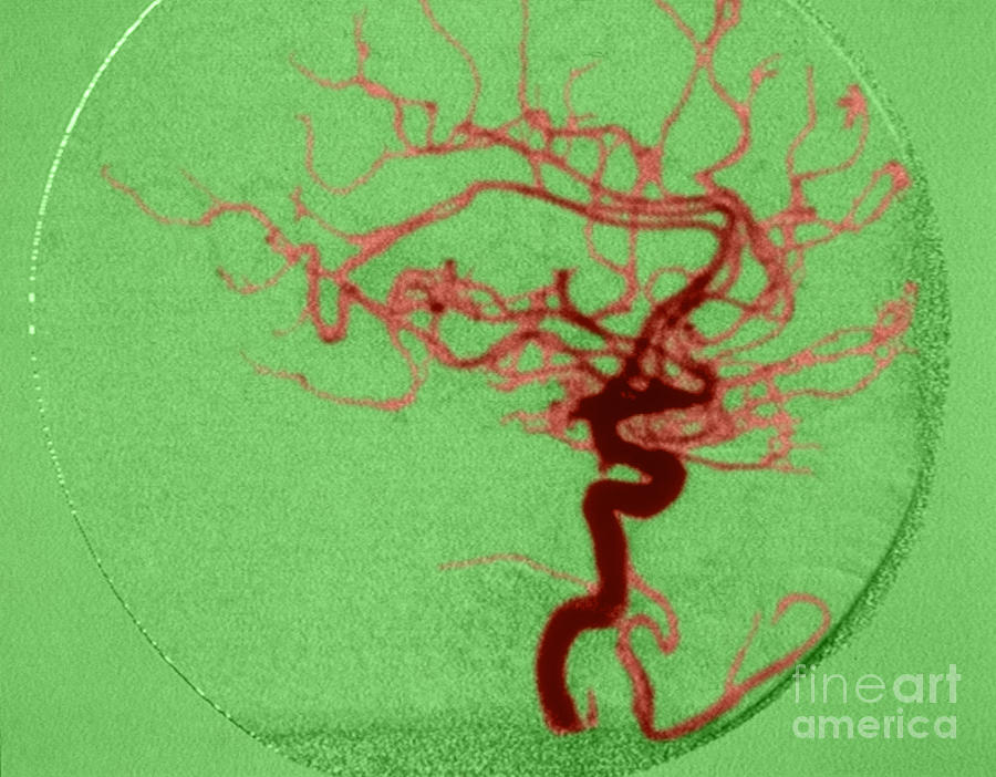 Cerebral Angiogram #3 Photograph by Science Source