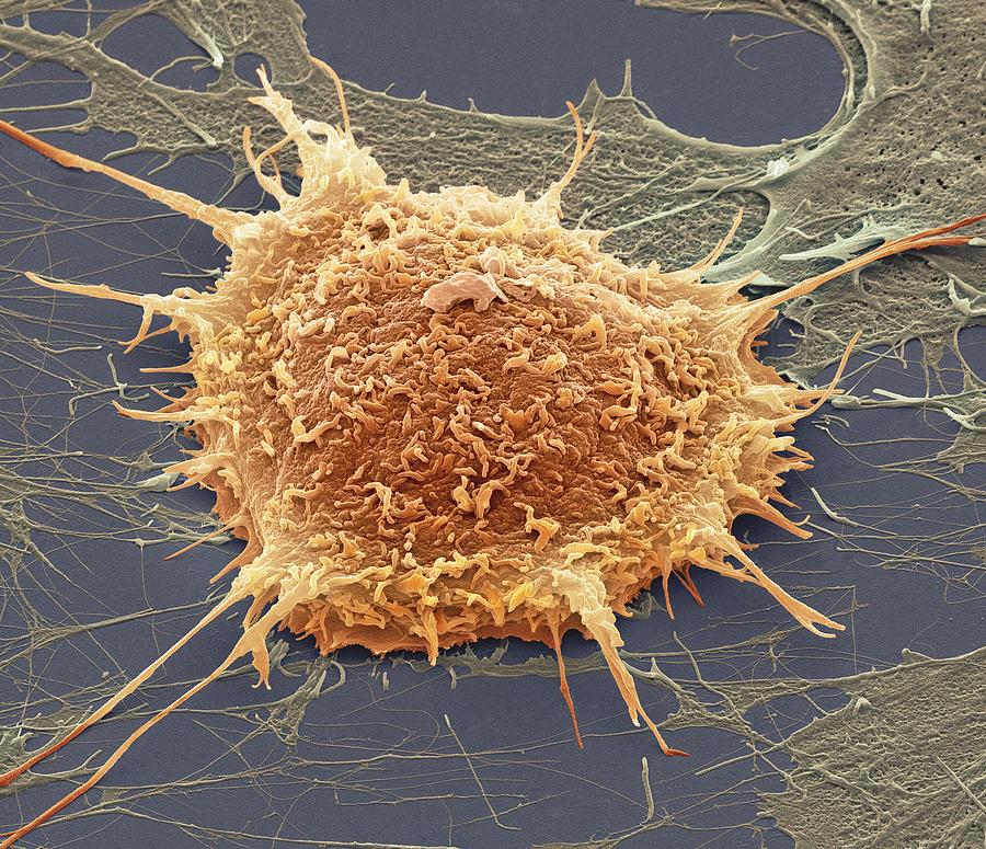 Cervical Cancer Cell, Sem Photograph by Steve Gschmeissner - Fine Art ...