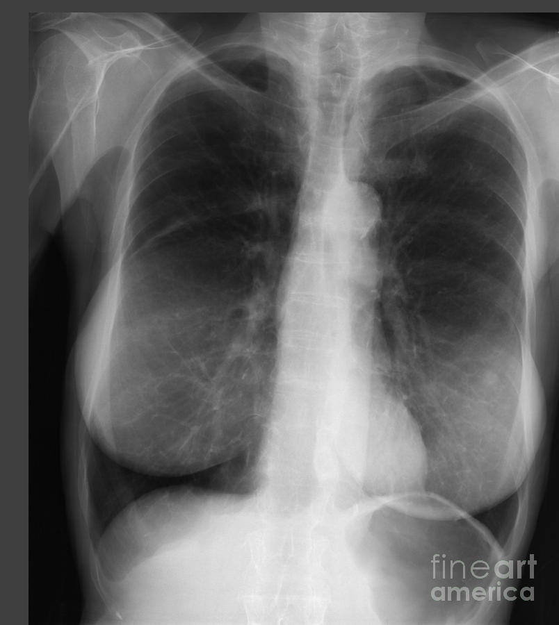 Chest Xray Of Female Photograph by Ted Kinsman Pixels