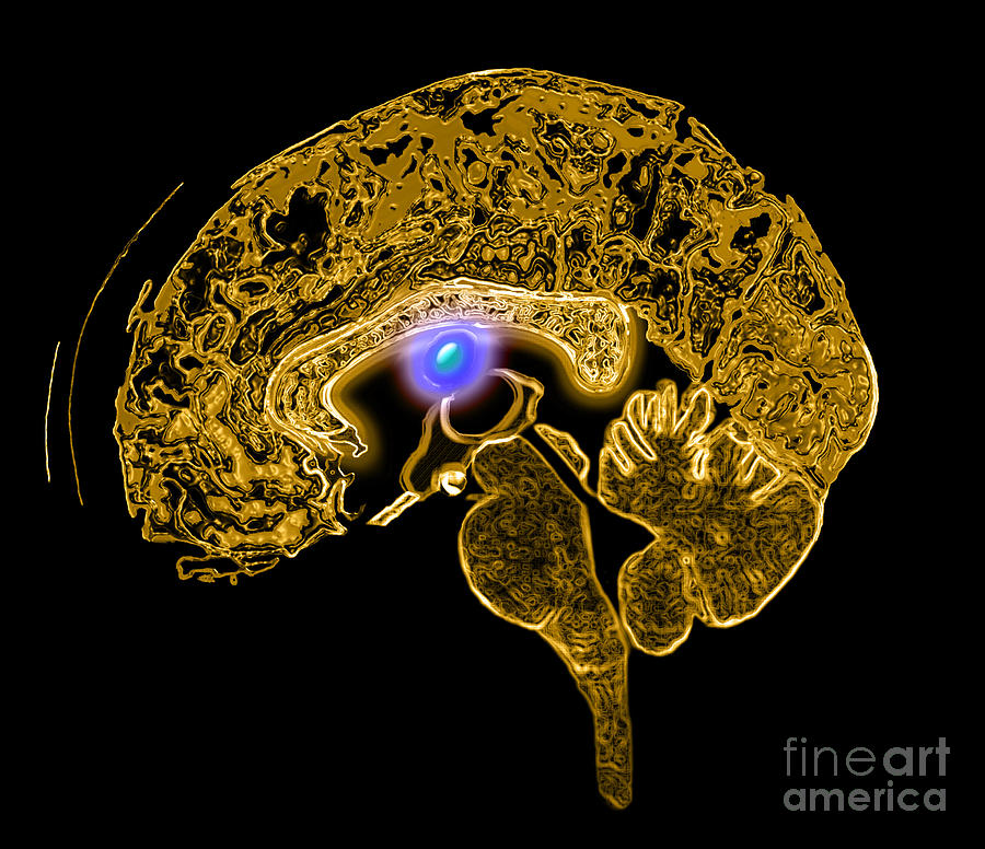 Colloid Cyst #3 Photograph by Medical Body Scans