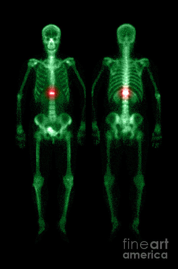 Compression Fracture #3 Photograph by Medical Body Scans