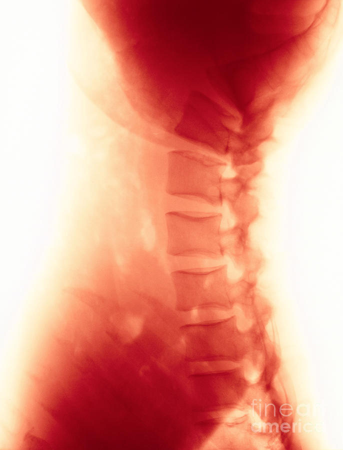 Compression In Lumbar Vertebrae #3 Photograph by Science Source