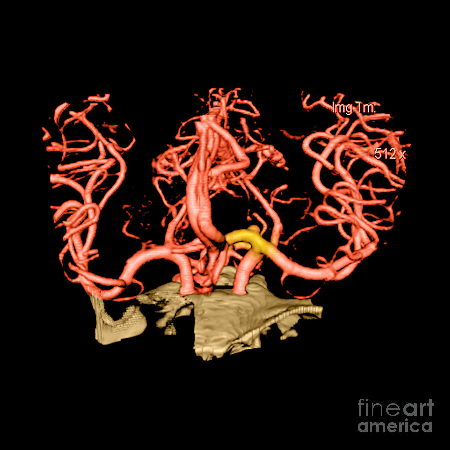 Ct Angiogram Of Aneurysm #3  by Medical Body Scans