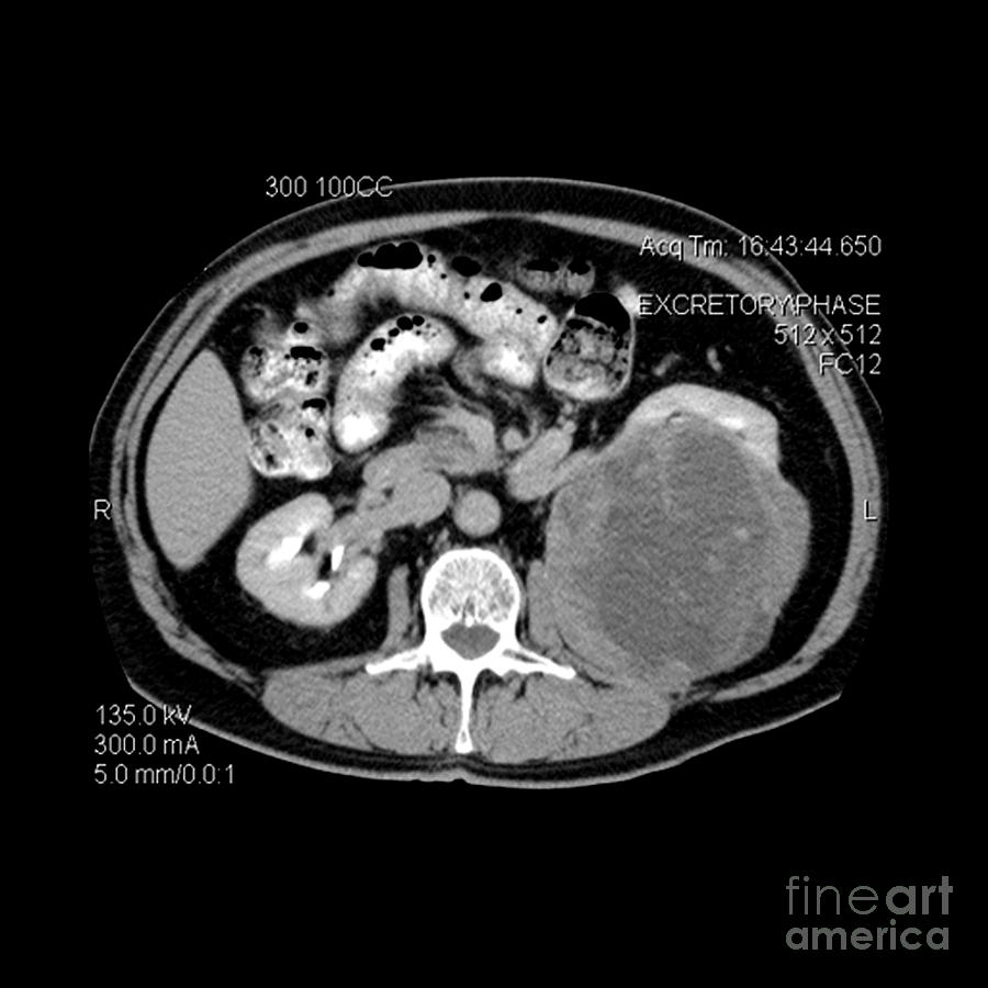 Ct Of Abdomen, Large Renal Carcinoma #3 Photograph by Medical Body Scans