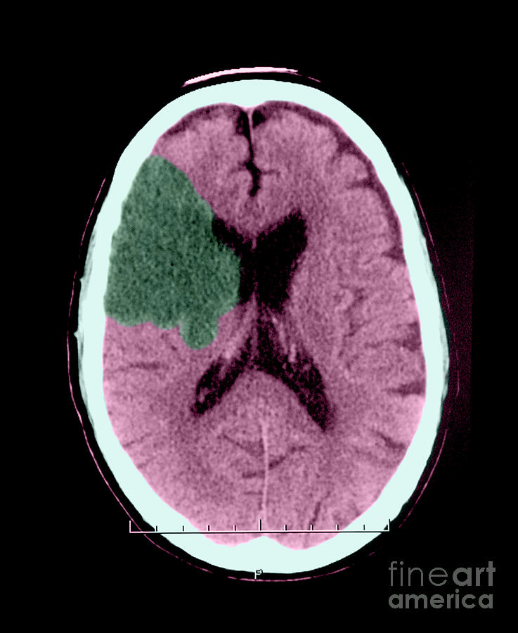 Ct Of Stroke #3 Photograph by Medical Body Scans
