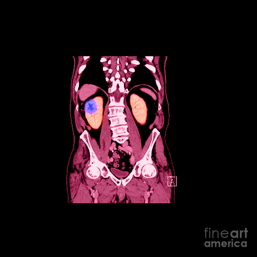 Ct Reconstruction Of Renal Cancer #3 Photograph by Medical Body Scans