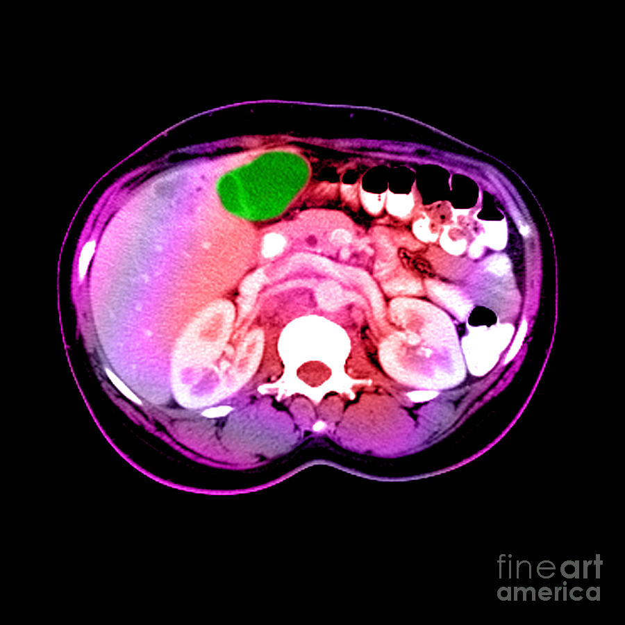 Ct Scan Of A Liver Tumor #3  by Medical Body Scans