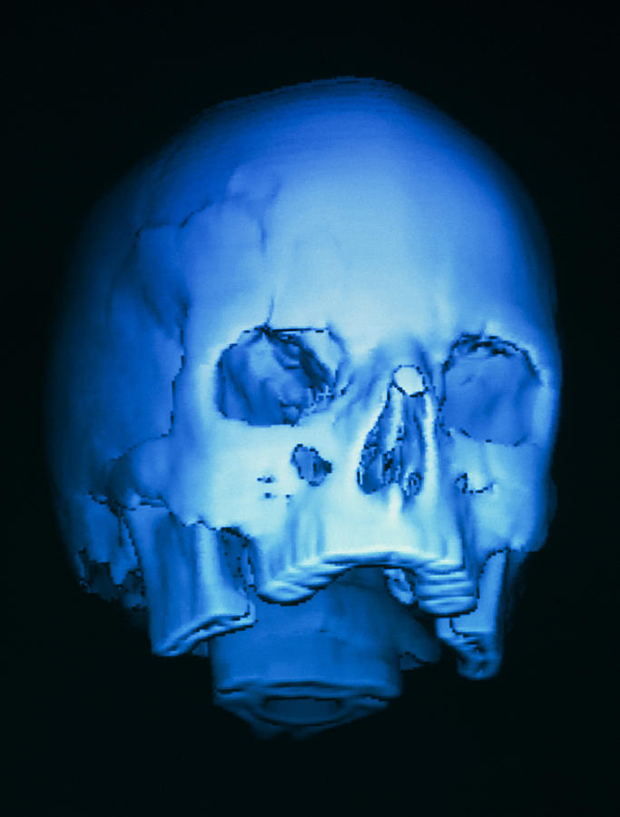 forehead skull fracture forehead skull fracture