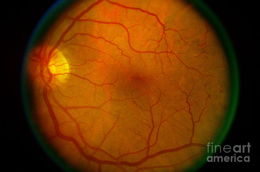 Diabetic Retinopathy #3 Photograph by Science Source