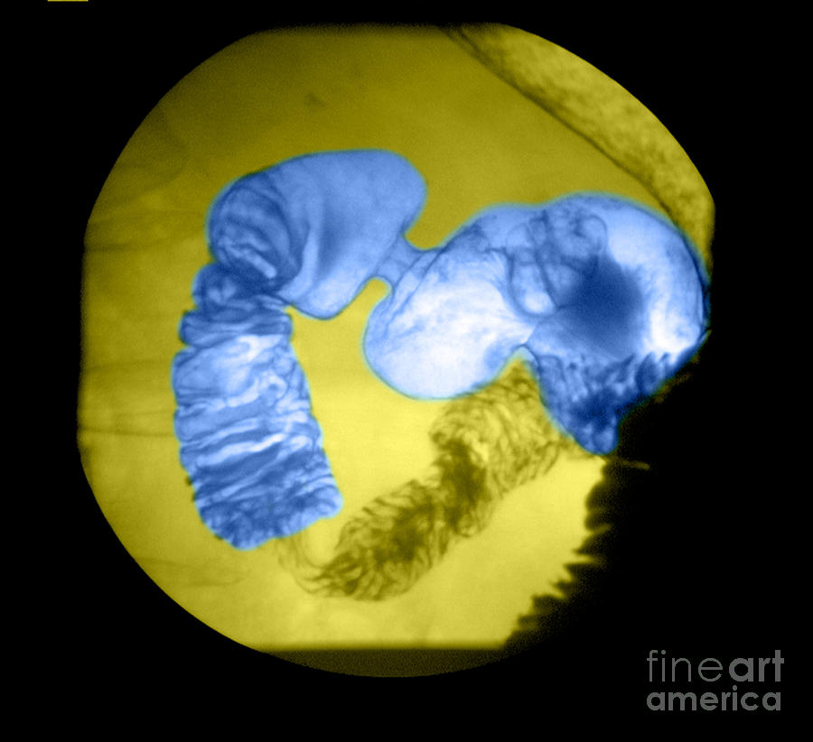 Anatomy Photograph - Distal Stomach And Duodenum #3 by Medical Body Scans