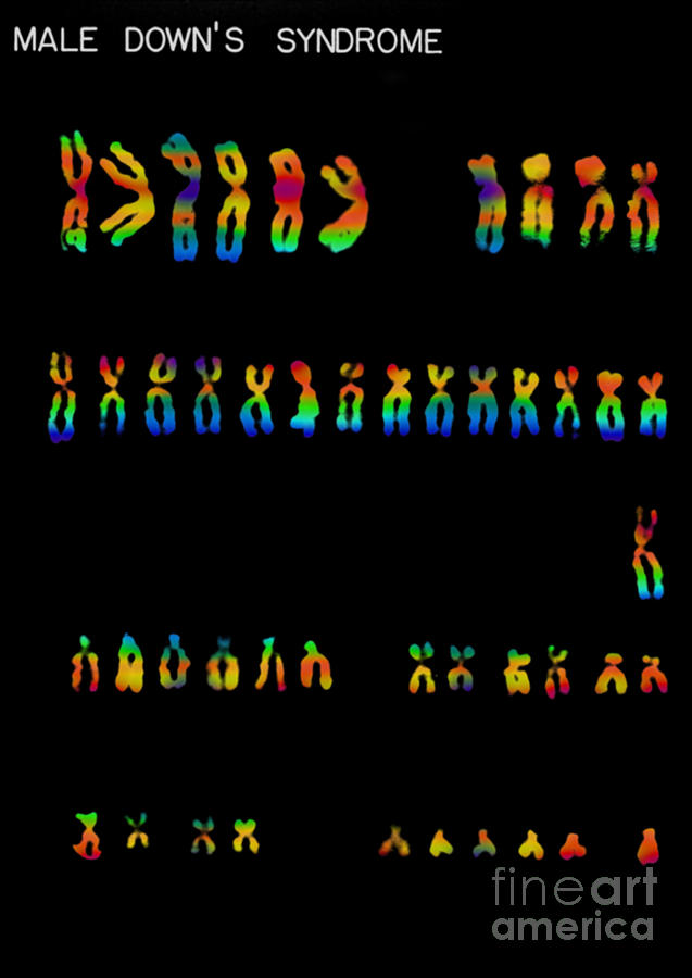 Downs Syndrome Karyotype #3 Photograph by Omikron