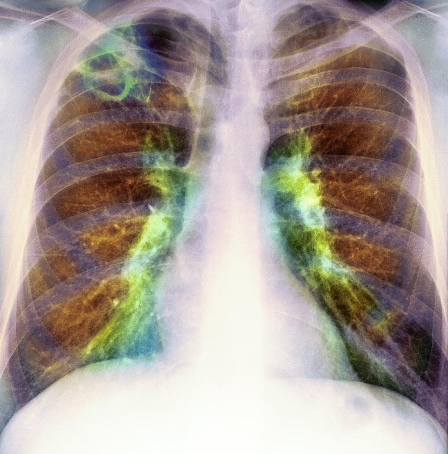 Drug Use Lung Damage, X-ray Photograph by