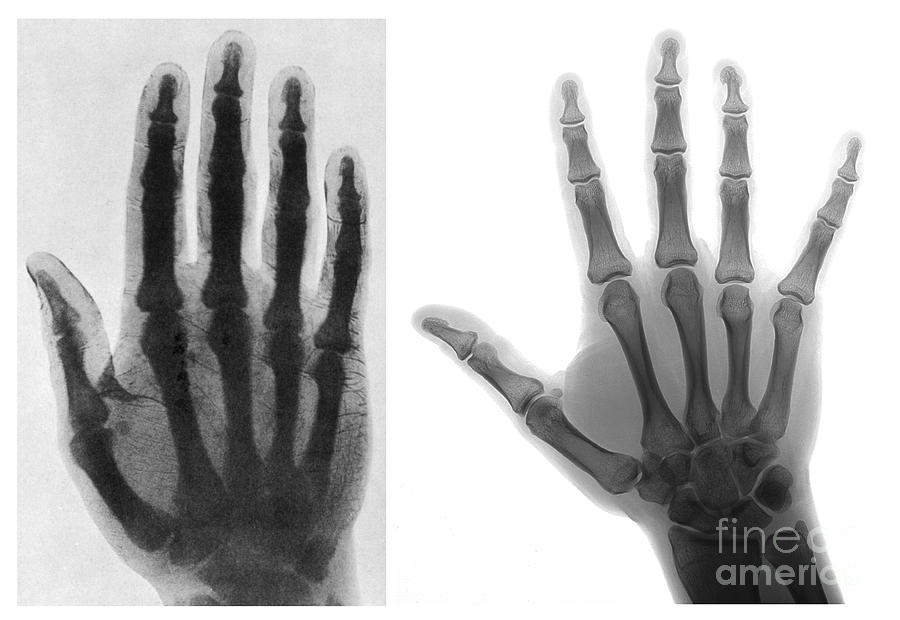 Early And Modern Hand X-rays #3 Photograph by Medical Body Scans