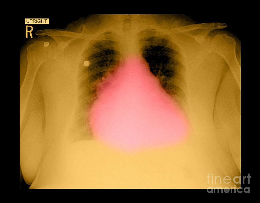 Enlarged Heart On Chest X-ray #3  by Medical Body Scans