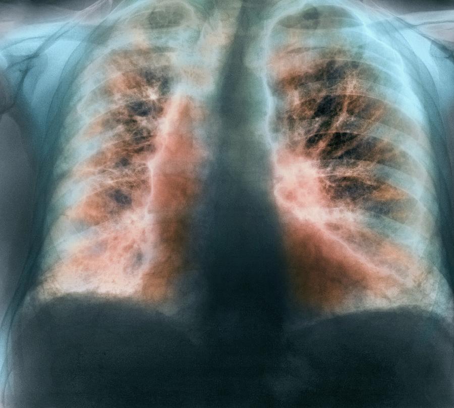 Idiopathic Pulmonary Fibrosis Photograph - Fibrosing Alveolitis, X-ray #3 by 
