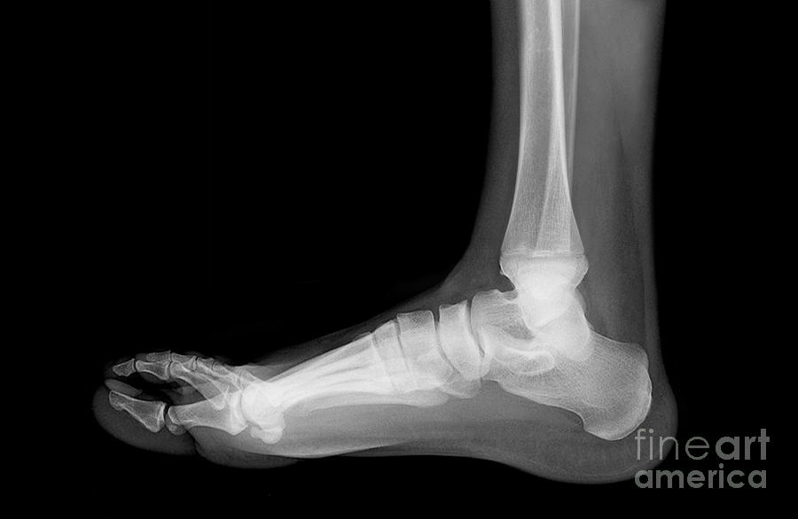 Flat Foot #3 Photograph by Medical Body Scans