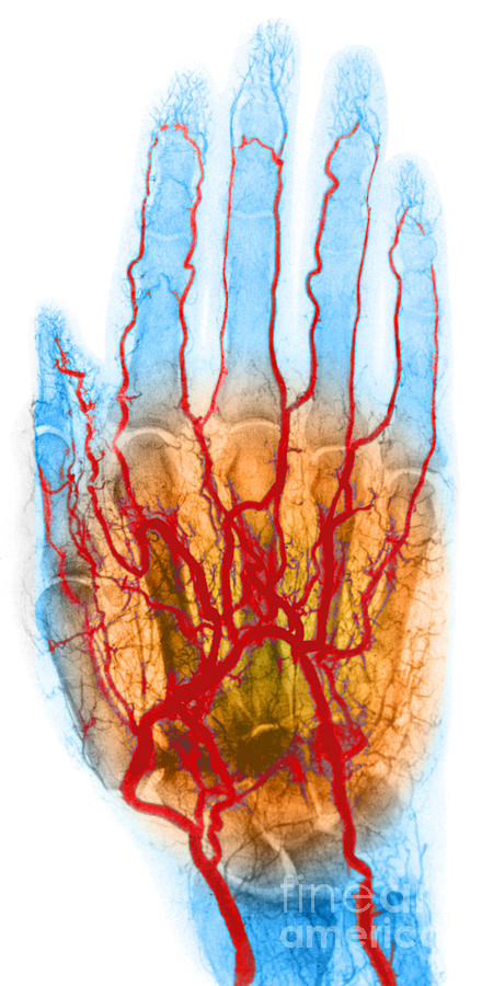 Hand Arteriogram #3 Photograph by Science Source