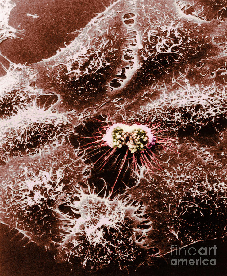Hela Cells With Adenovirus #3 Photograph by Science Source