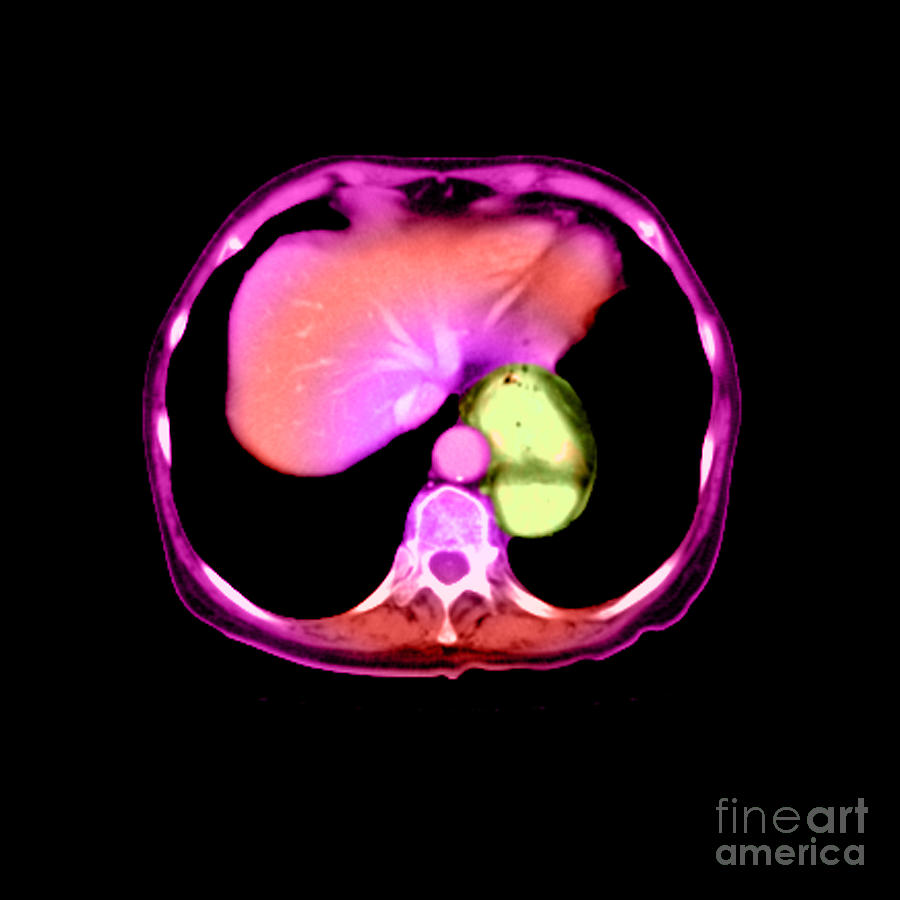 Hiatal Hernia #3 Photograph by Medical Body Scans