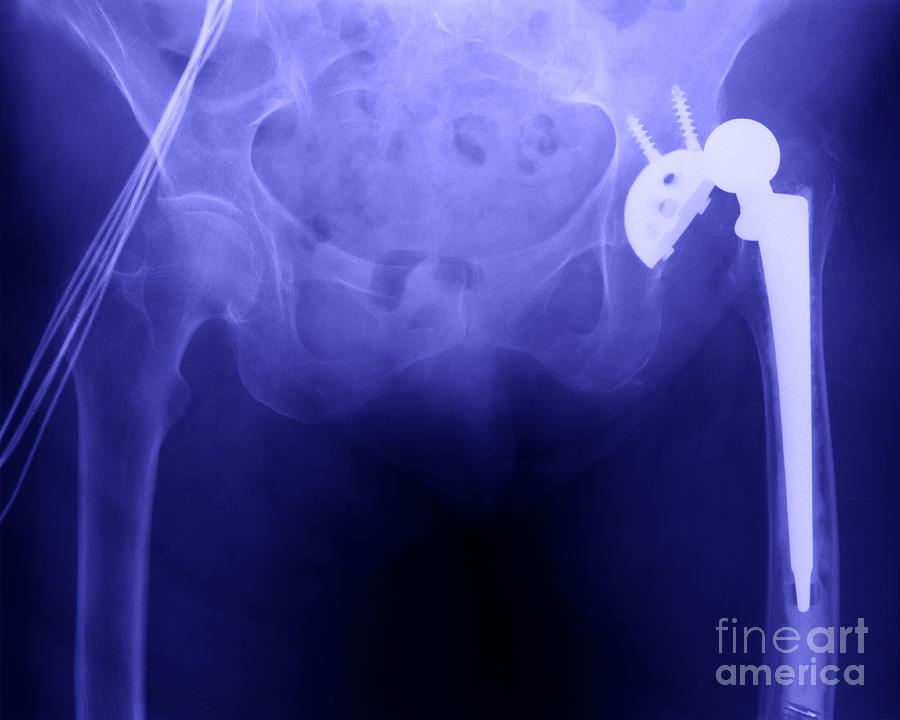 Hip Replacement #3 Photograph by Ted Kinsman