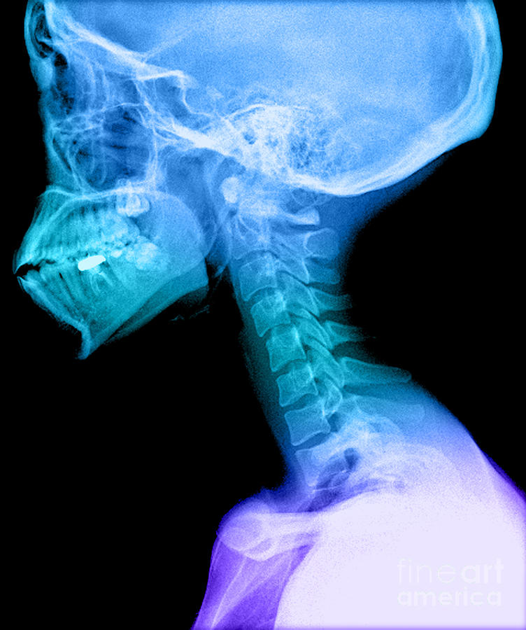 Human Skull And Cervical Spine #3 Photograph by Medical Body Scans