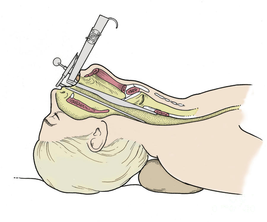 Illustration Of Laryngoscopy Photograph by Science Source - Fine Art ...