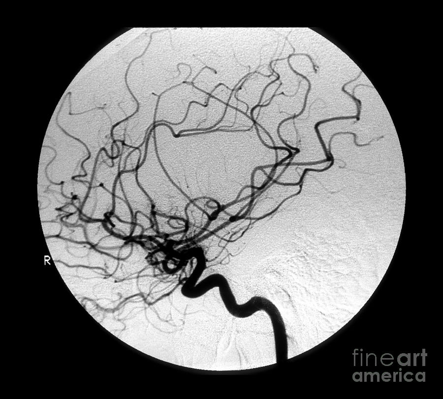 Internal Carotid Cerebral Angiogram #3 Photograph by Medical Body Scans