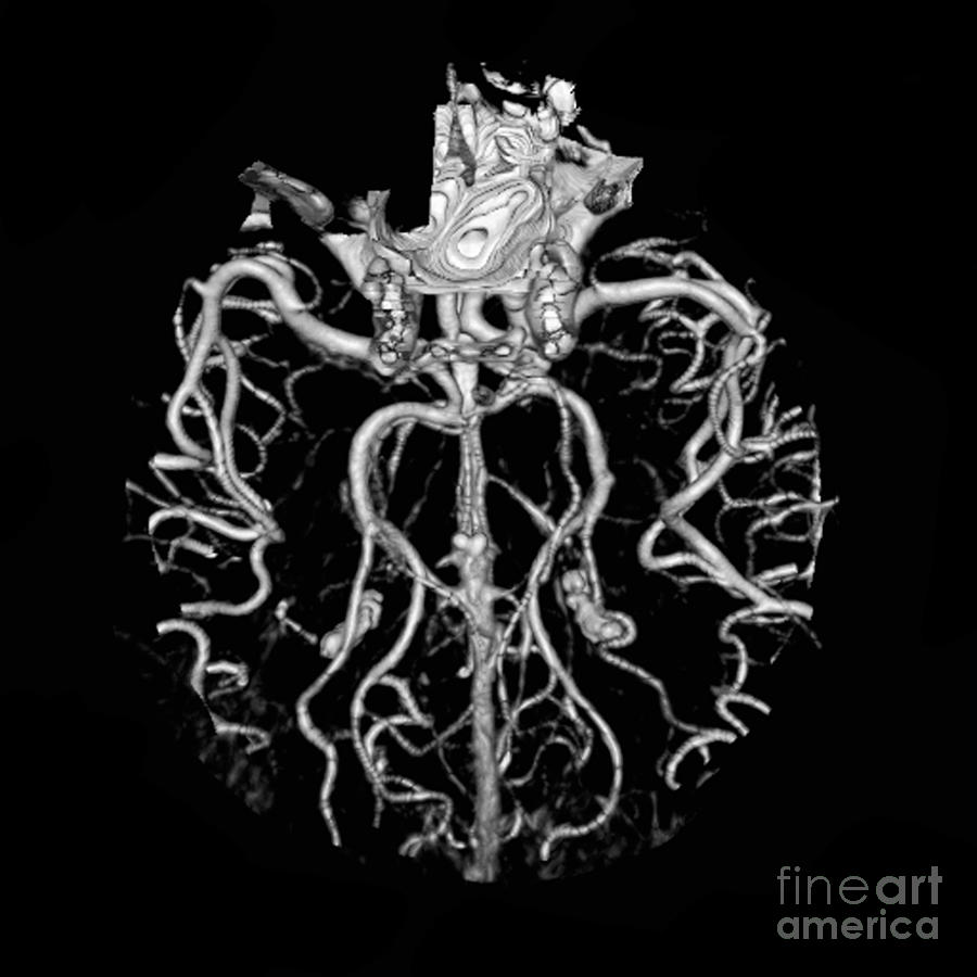 Intracranial Ct Angiogram #3 Photograph by Medical Body Scans